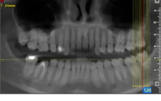 DVT Röntgen 3D Röntgen Zahnarzt Graz