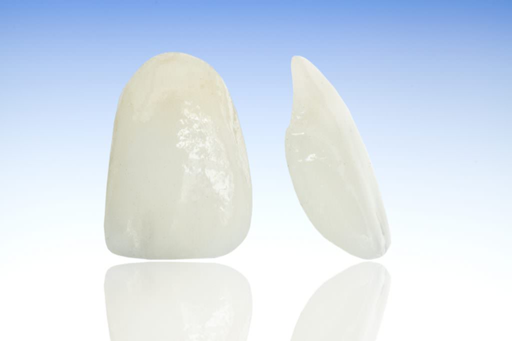 Veneers Zahnarzt Graz Andritz Veneers Zahnarzt Graz Andritz