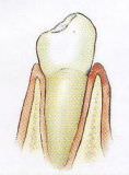 Zahnfleischprobleme und Paradontitis
