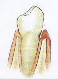 Zahnfleischprobleme und Paradontitis