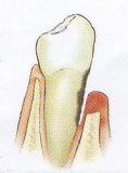 Zahnfleischprobleme und Paradontitis